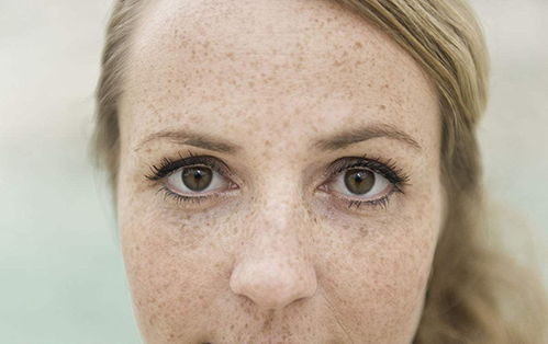 雀斑为什么点掉又出来了