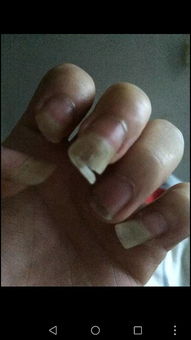 指甲老是断裂怎么回事儿