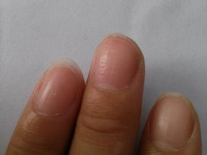 小孩指甲有白点是什么原因