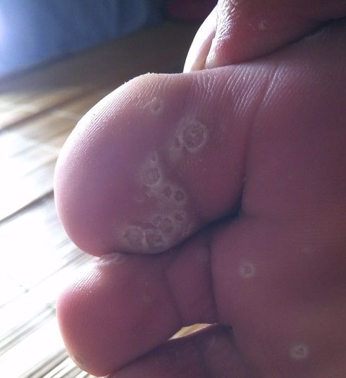 脚上长鸡眼图片 初期 治疗方法