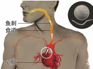 鱼刺卡住喉咙先别慌，先看看有哪些快速自救的小妙招？