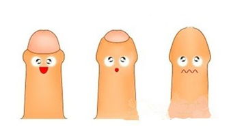 包茎手术后几天拆线