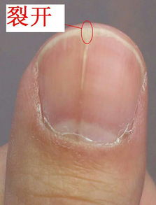 指甲裂开是什么原因