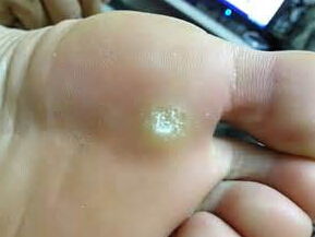 脚上频繁长鸡眼是怎么回事