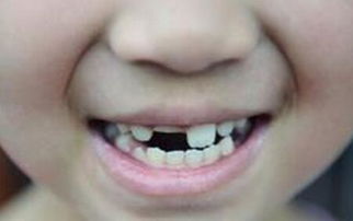 梦见掉牙齿流血是什么征兆女人