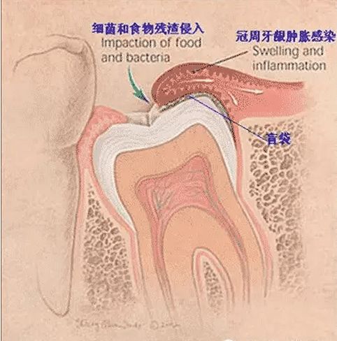 智齿旁边的肉肿了咽口水都疼