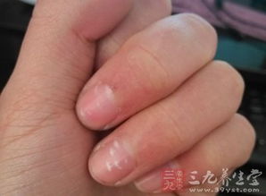 指甲盖上有白点是缺什么东西