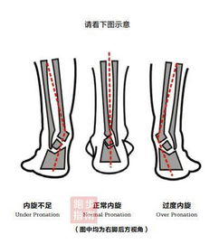 外翻脚型适合什么鞋