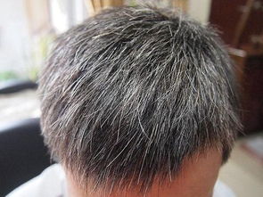 怎么解决白头发