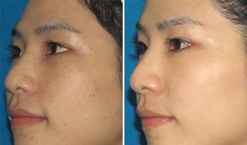 激光祛斑多少天能好，激光祛斑多少天掉痂