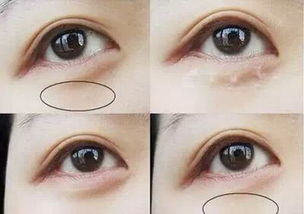 去除眼部脂肪粒的眼霜有哪些