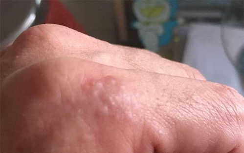 手脚起水泡痒是什么原因