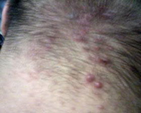 头皮毛囊炎怎么治才能除根，头部毛囊炎疙瘩怎么消除