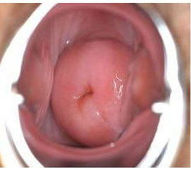 轻度宫颈糜烂要治吗多少钱