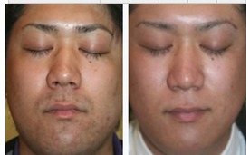 络腮胡怎么去除更干净