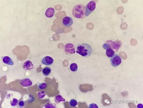 噬血细胞淋巴组织细胞增生症