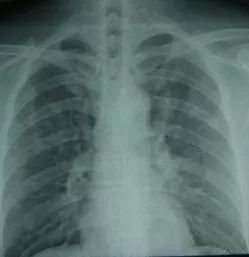 毛玻璃结节能治愈吗