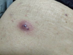 疮的读音是什么