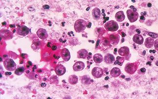 阿米巴脑膜脑炎有救吗