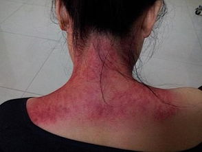 脖子刮痧的正确方向