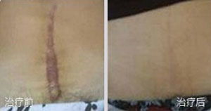 剖腹产的伤疤多久能恢复正常