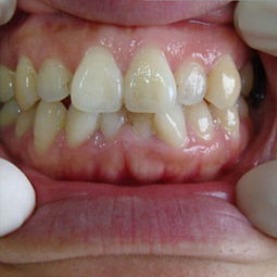 牙齿拥挤矫正大概多少钱