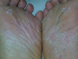 手上有脚气什么症状图片