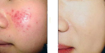 果酸换肤祛痘印要几次