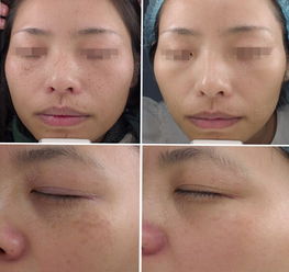 激光祛斑反黑要怎样才能消退