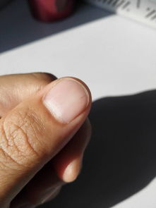 指甲里面有黑线什么原因