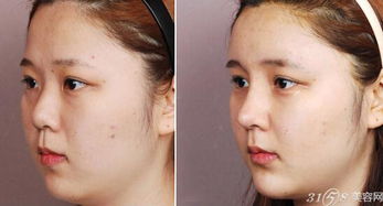 隆鼻对比照片 前后