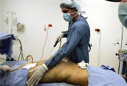 减肥手术哪种效果好