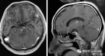 ct对人体的伤害有多大,ct x光区别
