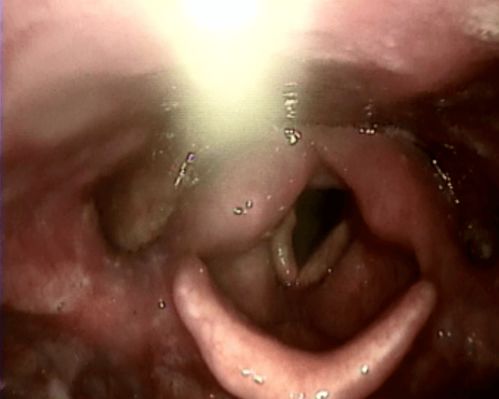 痉挛的拼音和意思，痉挛是什么意思?