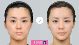 脸部下垂恢复小妙招