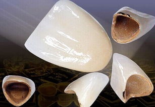 镍铬合金烤瓷牙对人体的危害