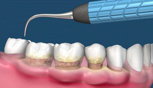 牙黄牙结石怎么去除小窍门