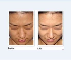 鼻子手术动画视频