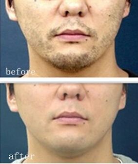 络腮胡子怎么去除,怎么去用什么!.