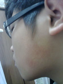 为什么脸颊两侧红一直退不了