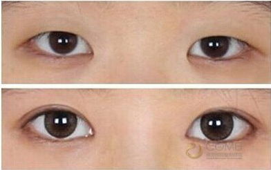韩式双眼皮手术价位多少