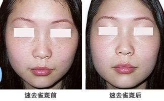 激光祛斑有疤吗会留疤吗