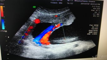 “有少量血流信号”是什么意思？