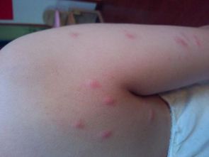 小孩脸上过敏怎么办怎么快速消除