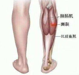 小腿肌肉怎么才能瘦