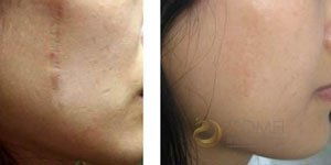 祛疤修复手术价格