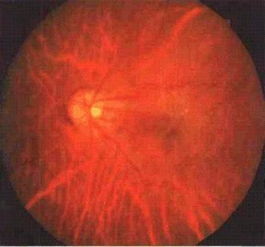 视网膜是什么东西？