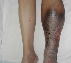 下肢深静脉血栓三大表现