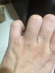 怎么判断手上是不是真菌感染