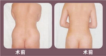 怎样减肥安全吸脂